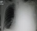 Massive left sided pleural effusion in a patient presenting with lung cancer.