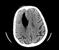 Large pneumocephaly secondary to surgical wound