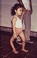 Child with polio deformity.