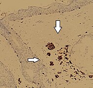 SOX10 immunohistochemistry in a dermal nevus, showing positively staining nevus cells (arrows)