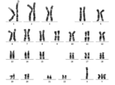 Karyotype of the XYYY syndrome