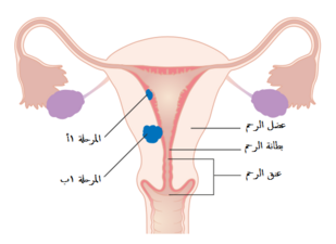 A diagram of stage IA and IB endometrial cancer