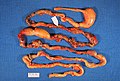 Alimentary tract of infant showing intestinal necrosis, pneumatosis intestinalis, and perforation site (arrow) (autopsy)