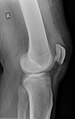 Quadriceps tendon rupture in plain X-ray: Incomplete rupture with haematoma in tendon.