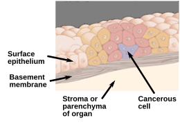 Description de l'image In situ carcinoma-en.svg.