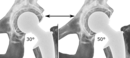 Acetabular inclination is normally between 30 and 50°.[90] A larger angle increases the risk of dislocation.[16]