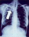 Tuberculosis creates cavities visible in x-rays like this one in the patient's right upper lobe.