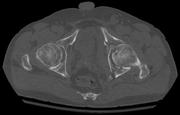 Axial CT image (viewed on bone windows) of a complex comminuted left acetabular fracture involving both anterior and posterior columns.