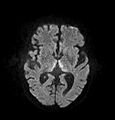 DWI showing restricted diffusion in the medial dorsal thalami consistent with Wernicke encephalopathy