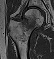 T1-weighted turbo spin echo MRI confirms a fracture, as the surrounding bone marrow has low signal from edema.
