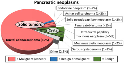 Relative incidence of various pancreatic neoplasms, with solid pseudopapillary neoplasm annotated at center right.[10]