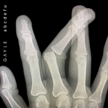 An x-ray style image of a hand reveals the bones of the middle finger bent out of place.