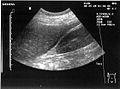 Ultrasonographic view of the abdomen demonstrating fluid within Morison's pouch