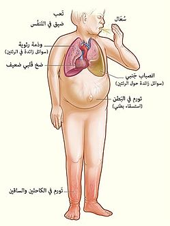 العلامات والأعراض الأساسية لقصور القلب