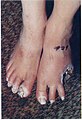 Patient's foot healing after 29 treatments.