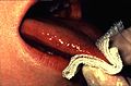 (Figure 10) Grasping the tip of the tongue with a piece of gauze will assist full protrusion and will aid examination of the more posterior aspects of the tongue's lateral borders