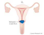 Stage IB2 cervical cancer