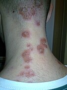 Impetigo on the back of the neck