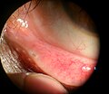 Lower lacrimal punctum through slit lamp biomicroscope