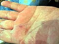 Lichen planus der Handinnenfläche