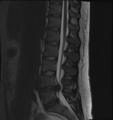 A rather severe herniation of the L4–L5 disc