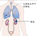 階段4的腎癌