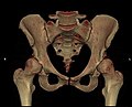 3D-CT-Rekonstruktion eines Beckens mit bds. HD