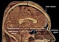Sagittal post mortem section through the midline brain. The corpus callosum is the curved band of lighter tissue at the center of the brain above the hypothalamus. Its lighter texture is due to higher myelin content, resulting in faster neuronal impulse transmission.