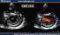 Two-dimensional parasternal and color Doppler images at the level of both ventricles that show the noncompacted:compacted wall ratio and how the color enters the intertrabecular recesses [4]