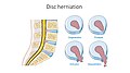 Illustration showing disc degeneration, prolapse, extrusion and sequestration