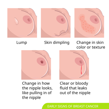 Cartoons of breasts with a lump, skin dimpling, red fluid leaking from the nipple, or changes in the appearance of the skin or nipple