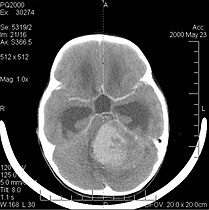 Meduloblastom