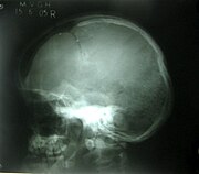 Lateral skull radiograph showing open skull sutures, large fontanelles, multiple wormian bones and underdeveloped paranasal sinuses.