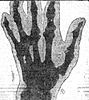 X-ray of Deacon McGuire's left hand published in newspapers