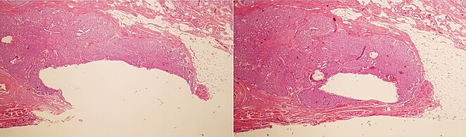 A separation artifact in top image makes the tumor look incompletely excised, but the next microtomy level (bottom image) shows a surgical margin of connective tissue.