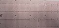 ECG de la même personne sans douleur ; notez les ondes biphasiques T dans les dérivations V2 et V3.