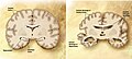 Comparaison d'un cerveau normal à droite et d'un cerveau atteint de la Maladie d'Alzheimer à gauche.