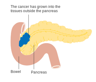 Stage T3 pancreatic cancer