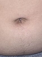 Adolescent male with hair growth below the navel.