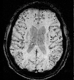 Description de l'image Cerebral amyloid angiopathy (CAA)-MRI.png.