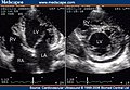 Two-dimensional apical four chamber and parasternal short axis images at the level of the ventricles show dilatation of both ventricles, multiple trabeculae and intertrabecular recesses in inferior, lateral, anterior walls, middle and apical portions of the septum and apex of the left ventricle. [1]