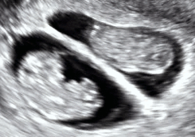 Dichorionic-diamniotic twins at 8 weeks and 5 days since co-incubation as part of IVF. The twin at left in the image is shown in the sagittal plane with the head pointing towards upper left. The twin at right in the image is shown in the coronal plane with the head pointing rightwards.