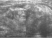 Liposarcoma. A heterogeneous mass consists of an upper hyperechoic portion corresponds to lipomatous matrix and areas of hypoechogenicity corresponds to nonlipomatous component is seen.[citation needed]