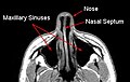 MRI image showing nasal septum.