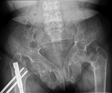 Brown tumors in the pelvis and a hip fracture.[18]
