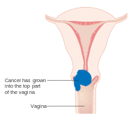 Stage IIA cervical cancer