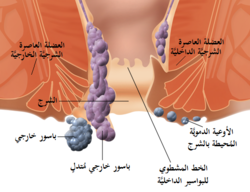 بواسير