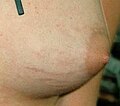 Stretch marks in a female breast