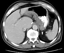 CT scan of Crohn's disease in the fundus of the stomach.