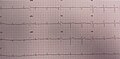 ECG chez une personne atteinte du syndrome de Wellens et en situation de douleur thoracique.